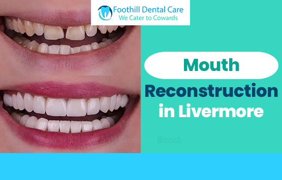 Mouth Reconstruction in Livermore